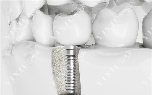 种植牙内部模具图 种植牙内部模具图