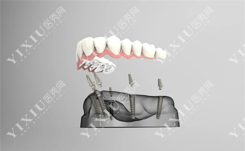 种植牙模具过程图 种植牙模具过程图