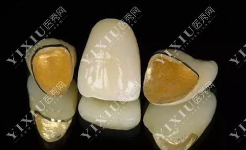牙冠材料照片展示 牙冠材料照片展示