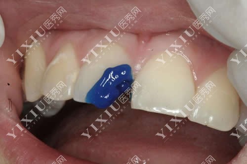 牙齿缺损实拍图 牙齿缺损实拍图