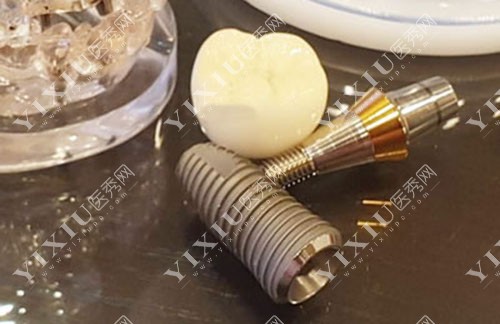 种植牙植体宣传图 种植牙植体宣传图