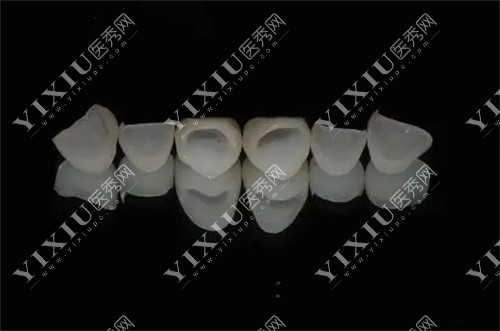 全瓷牙内冠展示图 全瓷牙内冠展示图