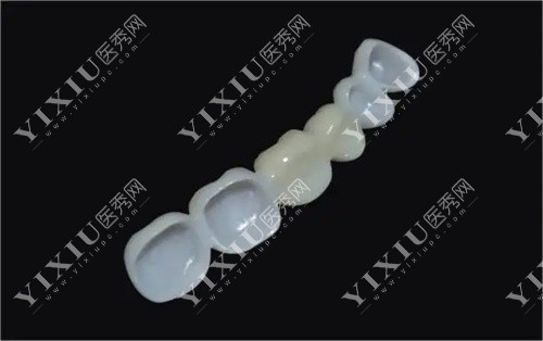 全瓷牙内外冠展示图 全瓷牙内外冠展示图