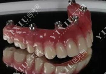 半口种植牙材料展示图 半口种植牙材料展示图
