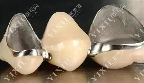 烤瓷牙内部展示图 烤瓷牙内部展示图