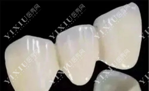 全瓷牙冠展示图 全瓷牙冠展示图