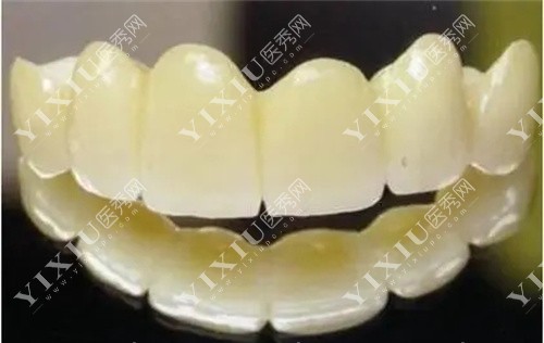 全瓷连桥牙冠图 全瓷连桥牙冠图