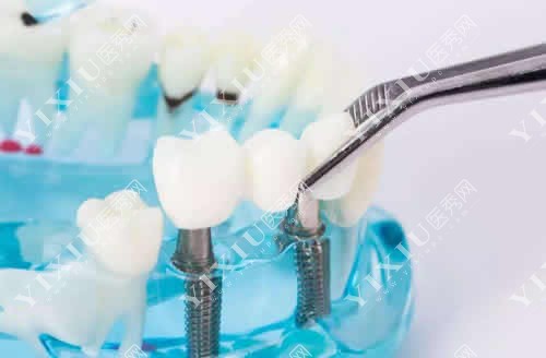 种植牙植体特写图 种植牙植体特写图