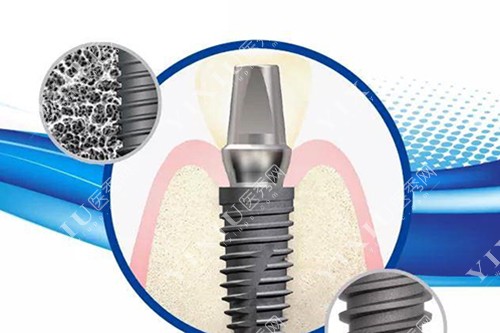韩国仕诺康种植体宣传图 韩国仕诺康种植体宣传图