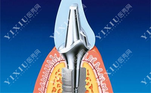 种植牙展示图 种植牙展示图