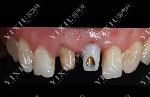 种植牙基台展示图 种植牙基台展示图