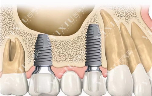 上颌牙种植内部卡通图 上颌牙种植内部卡通图