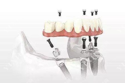 all-on-4即刻负重技术 all-on-4即刻负重技术