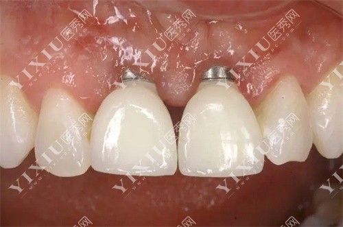 门牙种植体展示 门牙种植体展示