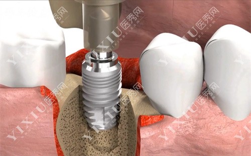 人工牙根植入图 人工牙根植入图