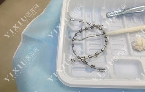 金属托槽矫正材料展示 金属托槽矫正材料展示