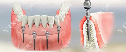 西泰克植体种植修复展示 西泰克植体种植修复展示