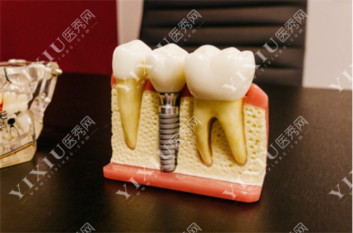 种植牙展示图 种植牙展示图