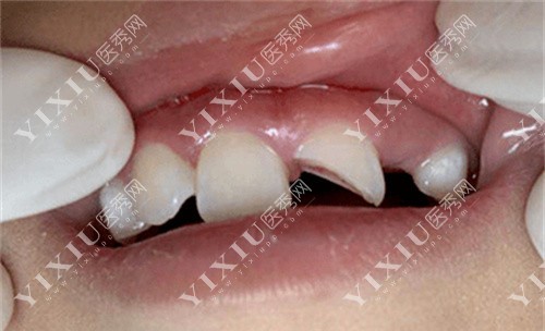 牙体受损图 牙体受损图