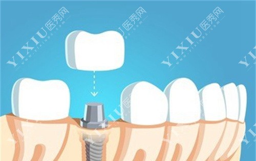 种植牙戴牙冠卡通图 种植牙戴牙冠卡通图