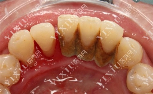 牙结石堆积图 牙结石堆积图