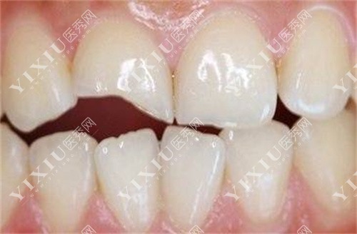 牙齿缺失一半图 牙齿缺失一半图