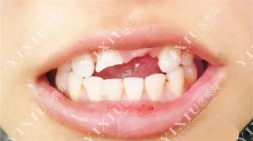 门牙断裂图 门牙断裂图