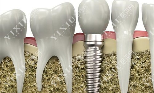 植体植入展示图 植体植入展示图