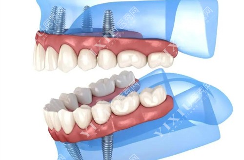 种植牙内部展示图 种植牙内部展示图
