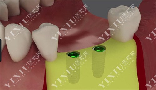 种植牙槽骨展示图 种植牙槽骨展示图