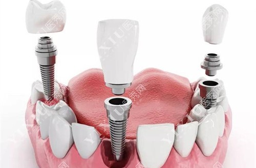 种植牙产品分解图 种植牙产品分解图