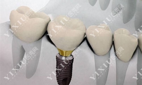 种植体模具展示图 种植体模具展示图