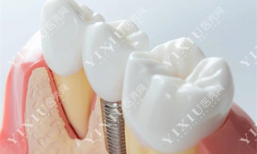 种植牙模具图 种植牙模具图