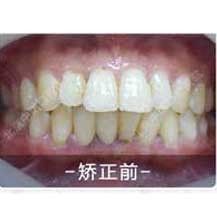 北京中诺口腔医院正畸科金属自锁矫正实例分享！_北京中诺口腔医院整形案例