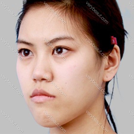 双颚手术后!萌妹子就是我啦!!!