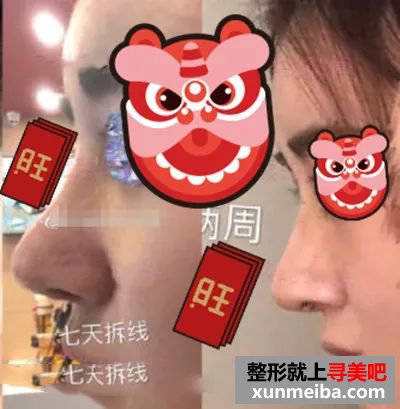 上海九院魏皎做鼻子术后图 图片