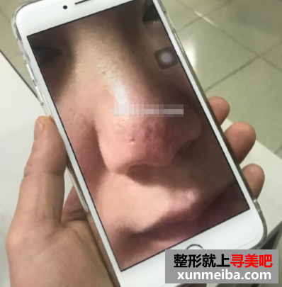 李圣利修复的膨体鼻 图片