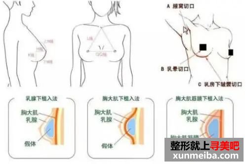 常见假体丰胸切口方式: 图片