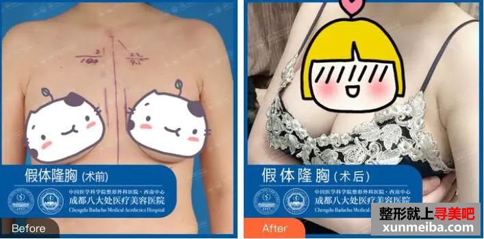 假体隆胸案例效果展示 图片