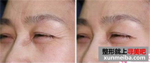 热玛吉紧肤术第四代和5代,差别归根结底有多大