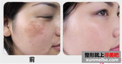 激光医美去红血丝会全面吗?一次488会添多少?