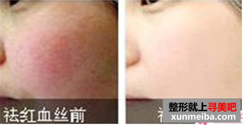 激光医美去红血丝会全面吗?一次488会添多少?