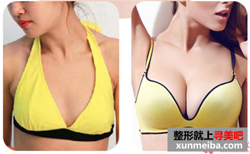 蜜桃假体隆胸手术过后哪些事情能够帮助我们增加愈合?多长时间可以愈合?