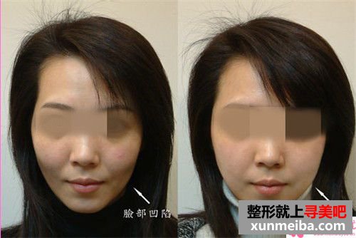 自体脂肪填充面部手术三个月可以完全治愈吗?