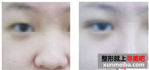 通过现实例子解说鼻尖朝天整形?估算收费是怎样?