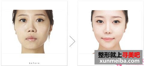 通过现实例子解说鼻尖朝天整形?估算收费是怎样?