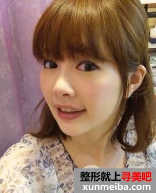 玻尿酸效果好吗?让这位妹子告诉你!