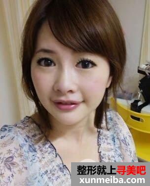 玻尿酸效果好吗?让这位妹子告诉你!