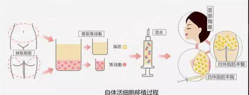 填充的脂肪会吸收，那可以让医生一次性多打点吗?