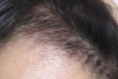 植发际线的经历分享，在2个月新发的长度还是很惊喜的